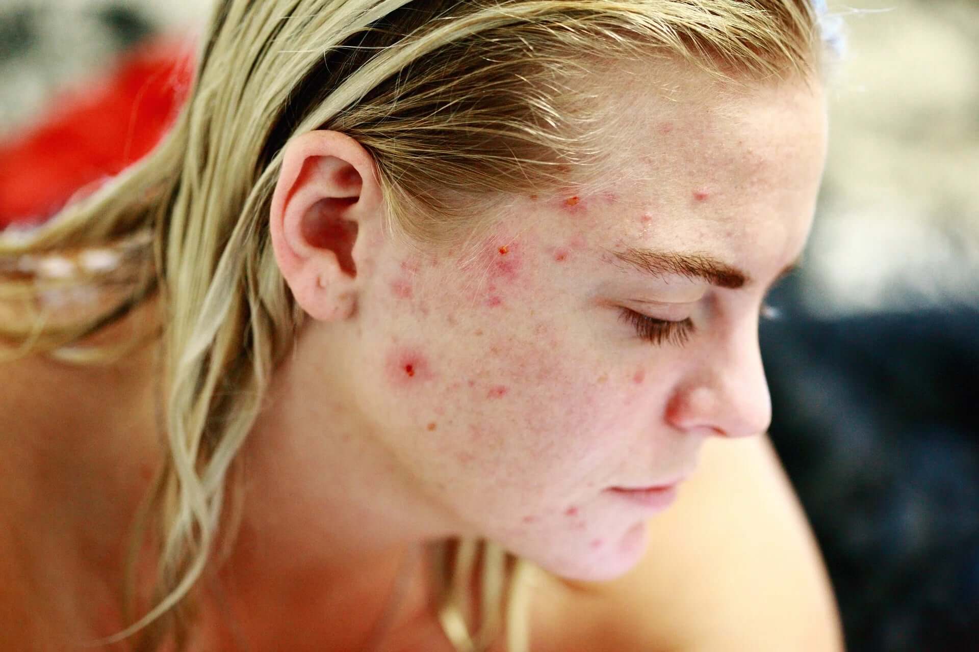 CBD gegen Akne – wie Du wieder eine schöne Haut bekommst